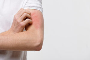 Allergy_1
