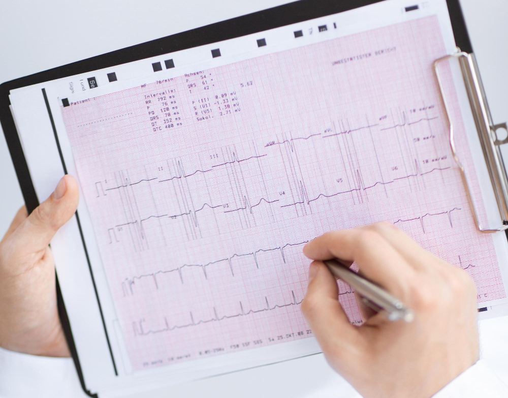 ECG