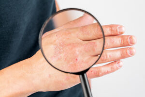 ECzema