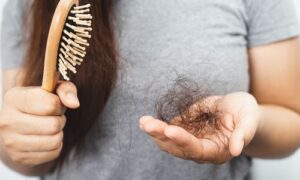 hairloss